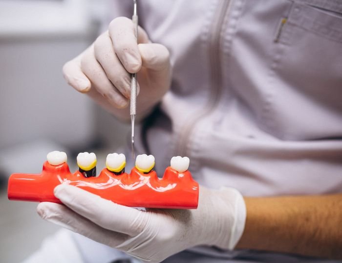 What Are the Benefits of Dental Implants?